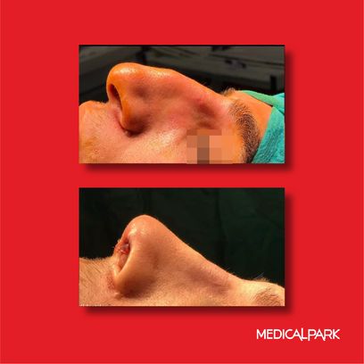 Obesity Surgery | Before After