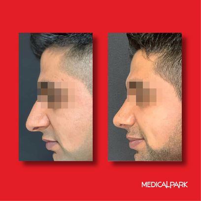 Obesity Surgery | Before After