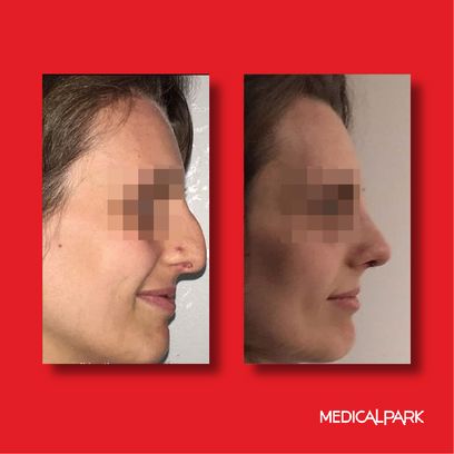 Obesity Surgery | Before After