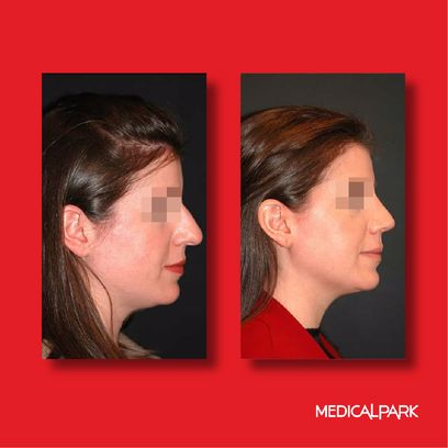 Obesity Surgery | Before After